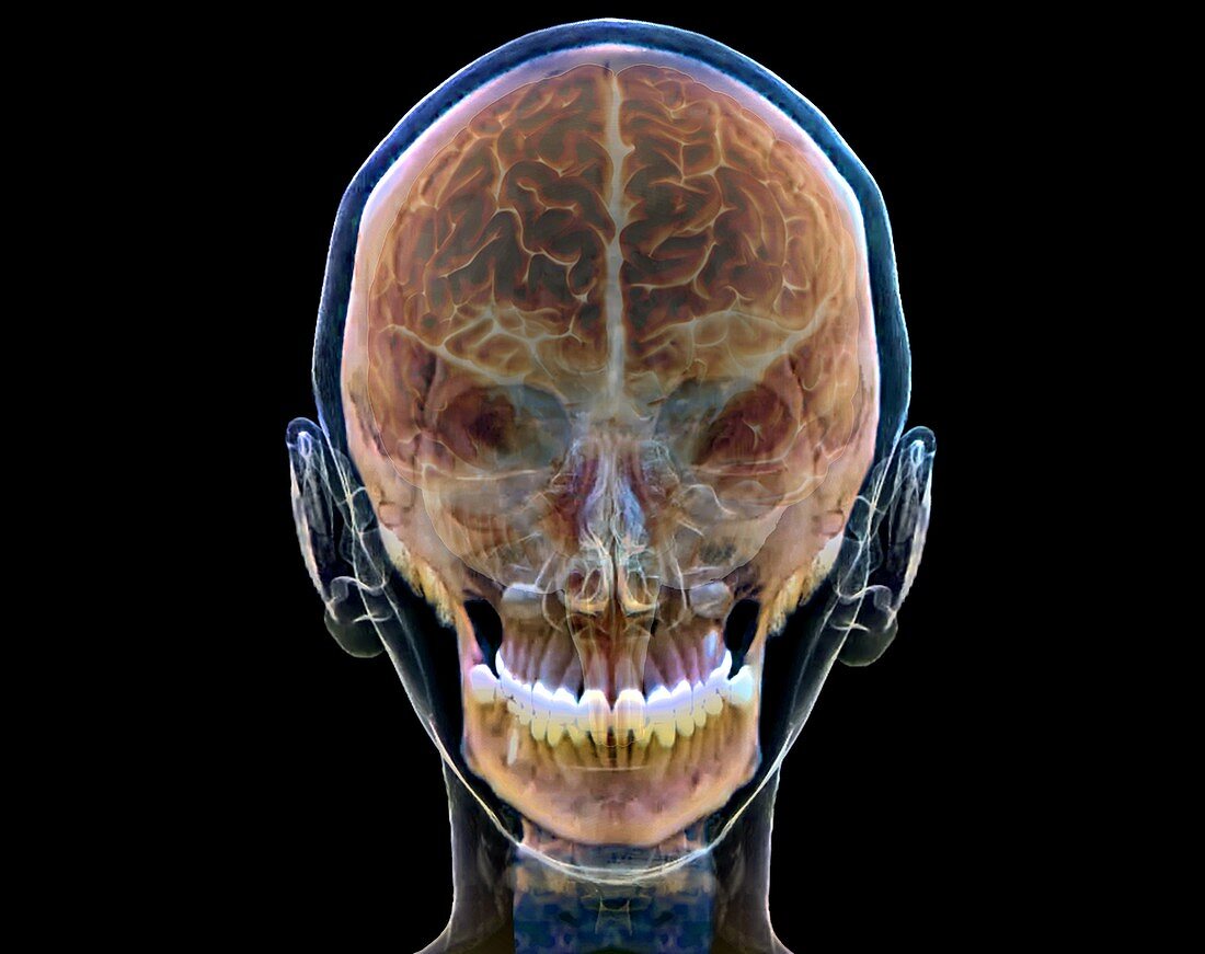 Normal human brain, 3D CT scan