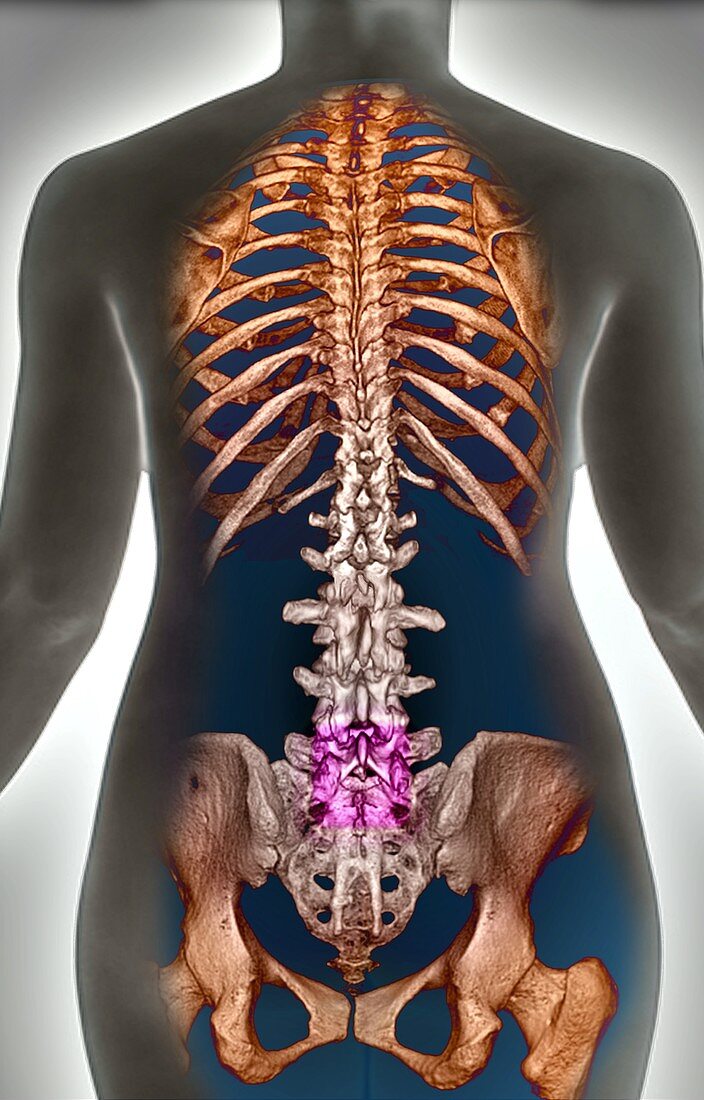 Normal spine, 3d CT scan