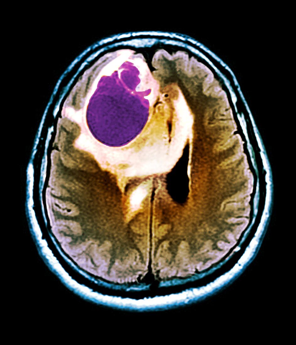 Brain tumour, MRI