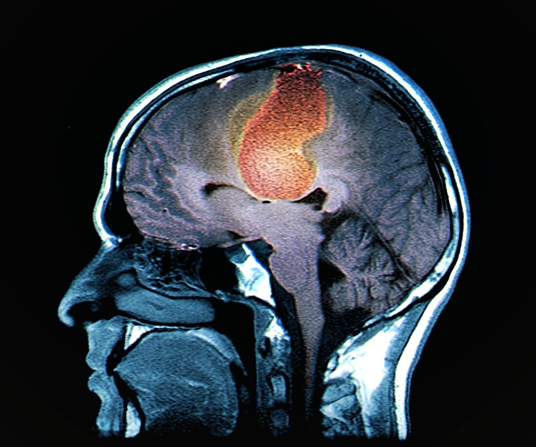 Brain cancer, MRI