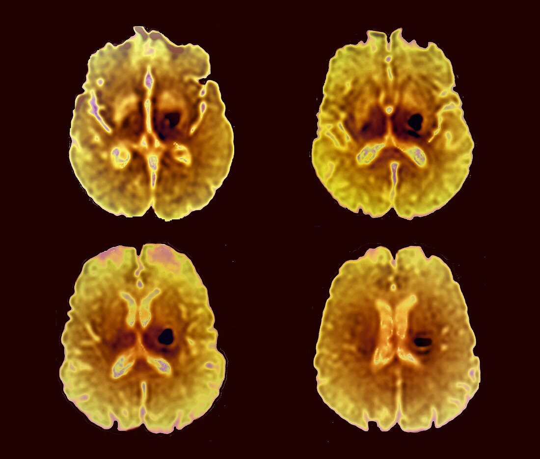 Intracerebral haemorrhage, MRI