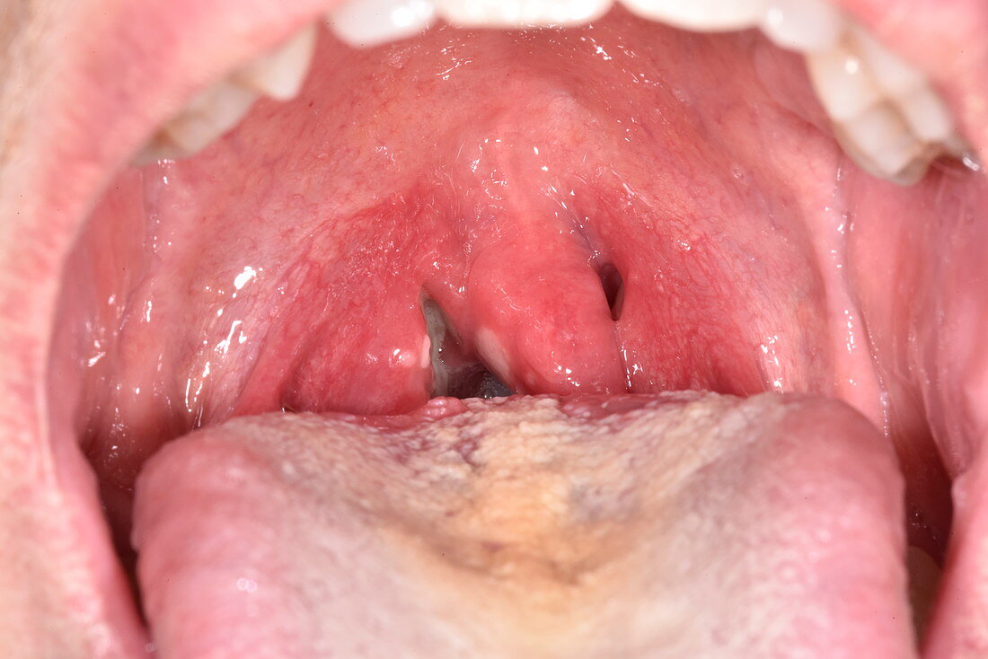 Gonococcal tonsillitis