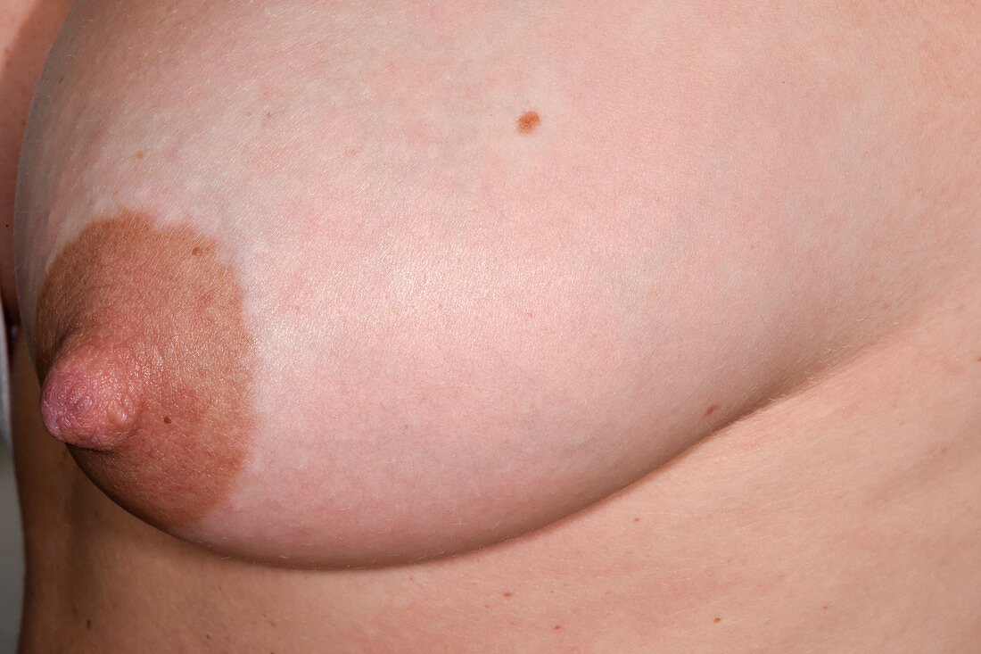 Mastitis in breast-feeding woman