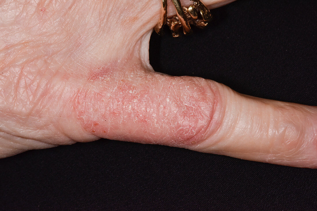 Contact dermatitis due to jewellery