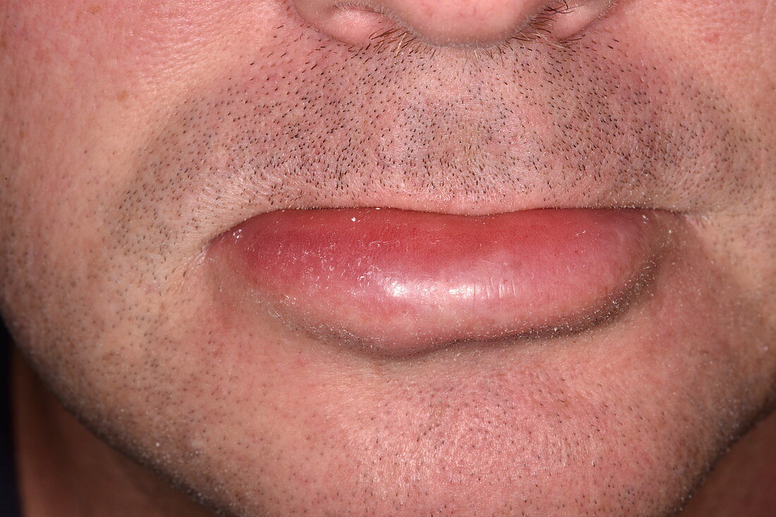 Angioedema of the lower lip due to wasp sting