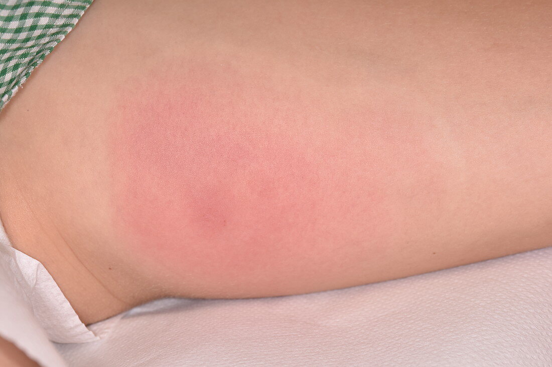 Allergic reaction to an insect bite