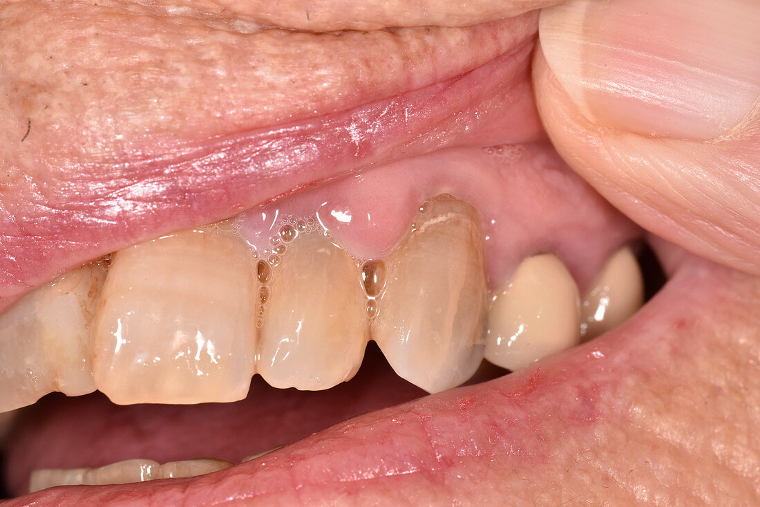 Drug-induced gum hyperplasia