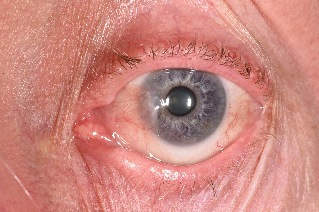 Pterygium eye disorder