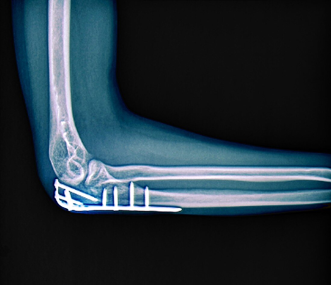 Fixed elbow fracture, X-ray