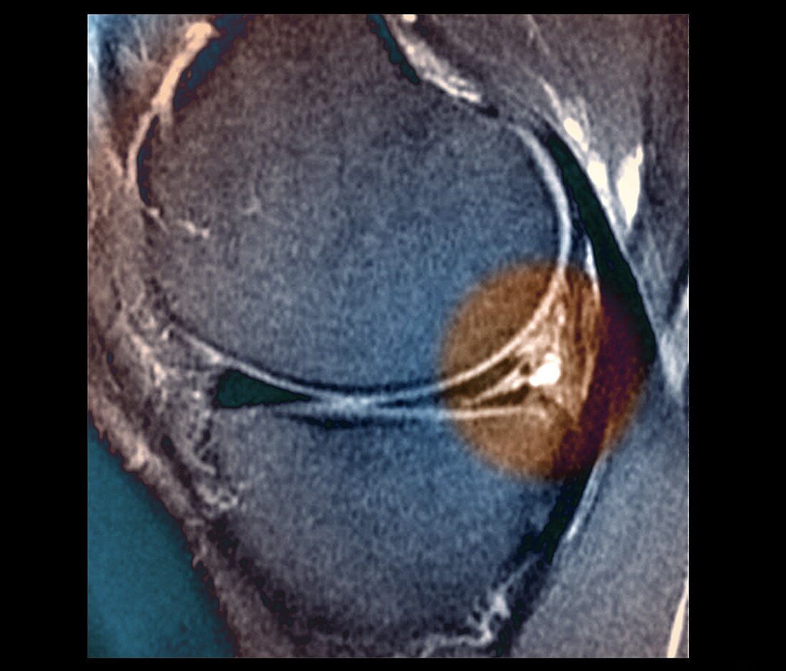 Knee meniscus injury, MRI scan