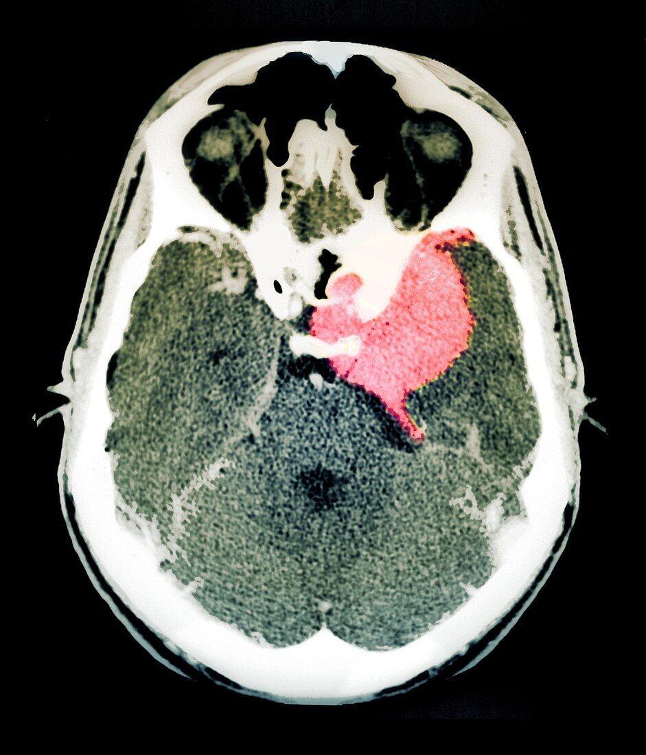 Meningioma brain tumour, CT scan