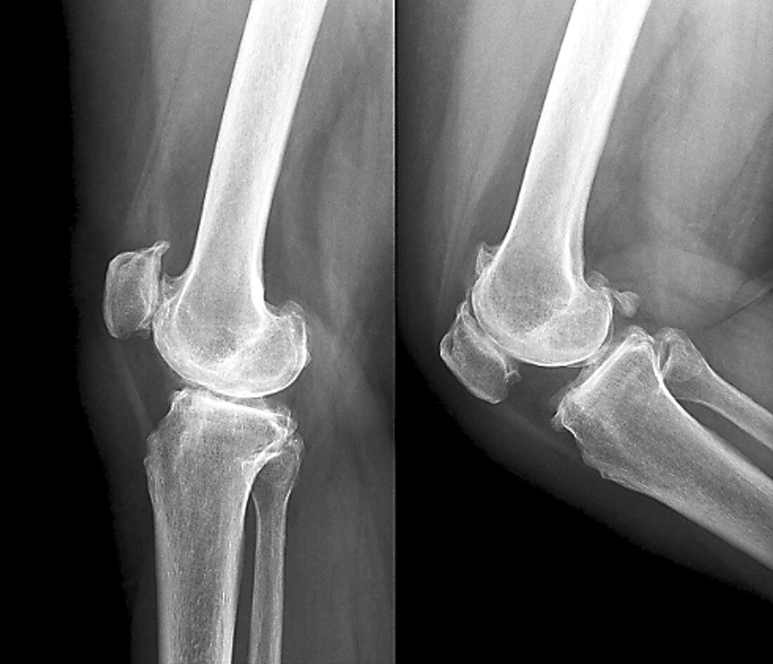 Osteoarthritis of the knee, X-rays