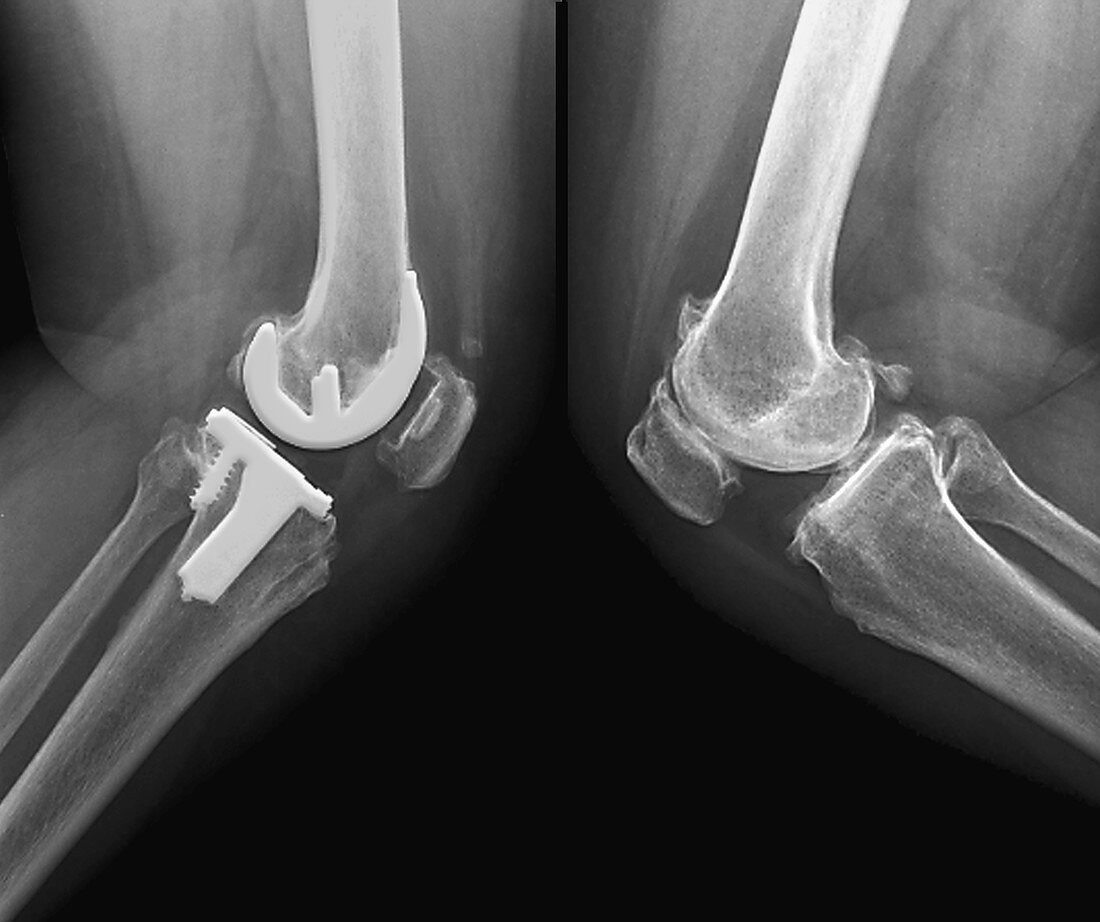 Knee osteoarthritis and total knee replacement, X-rays