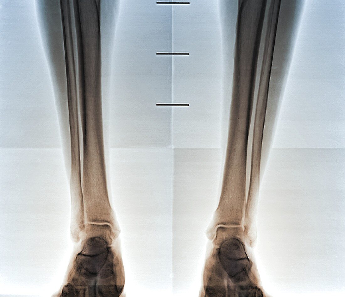 Healthy lower legs, X-ray