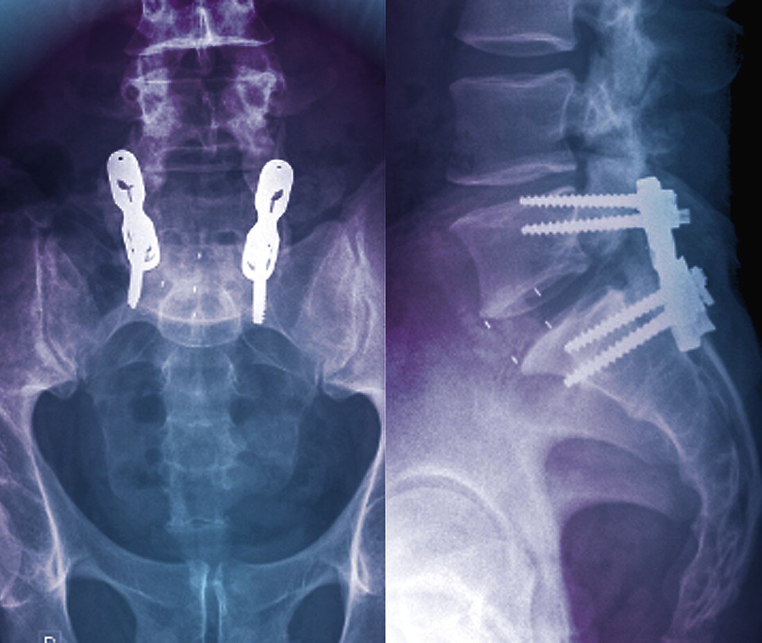 Intervertebral fixing, X-rays