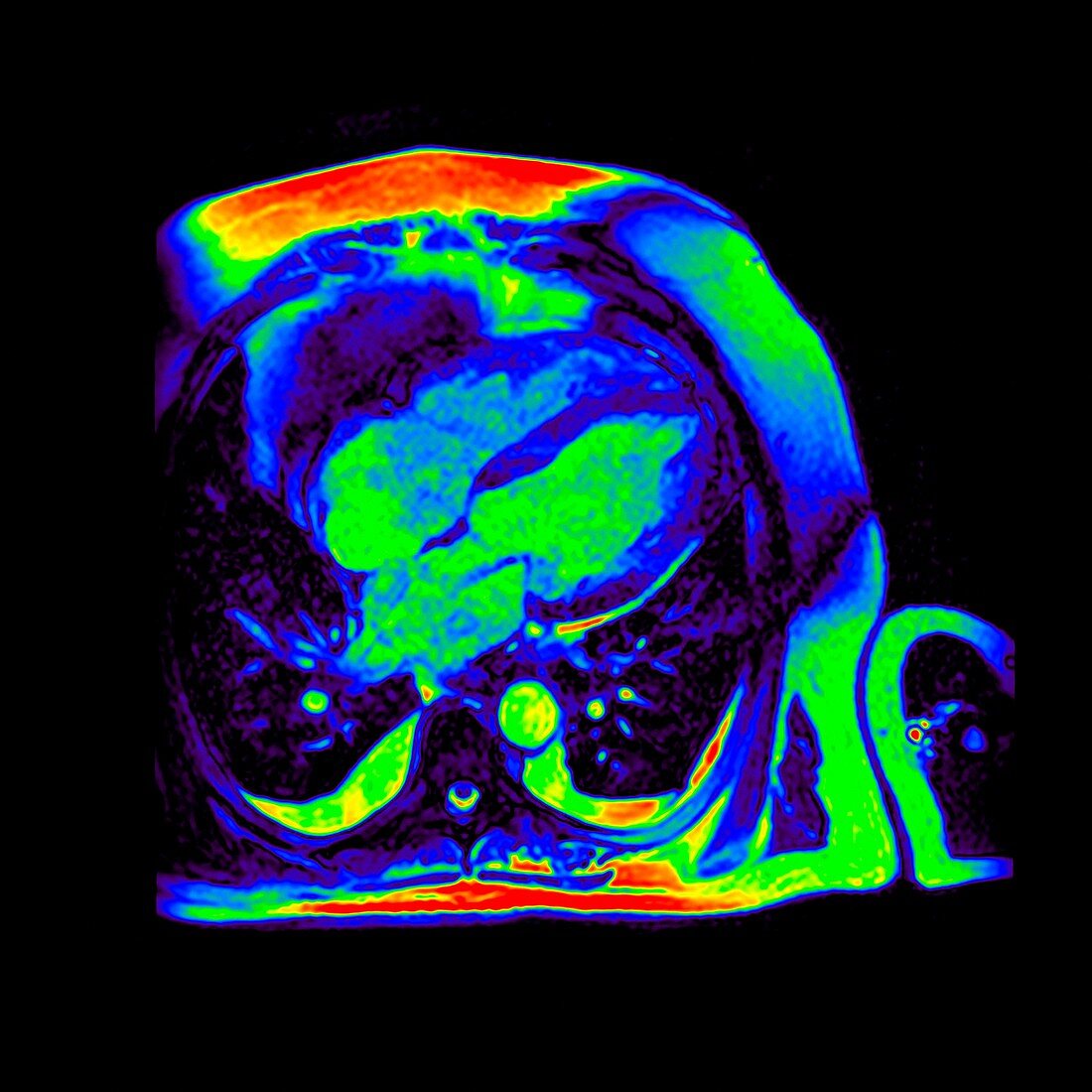 Mitral valve failure, MRI scan