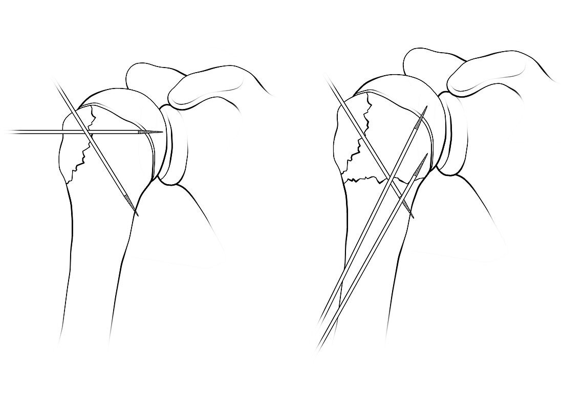 Kirschner wires in shoulder fracture surgery, illustration