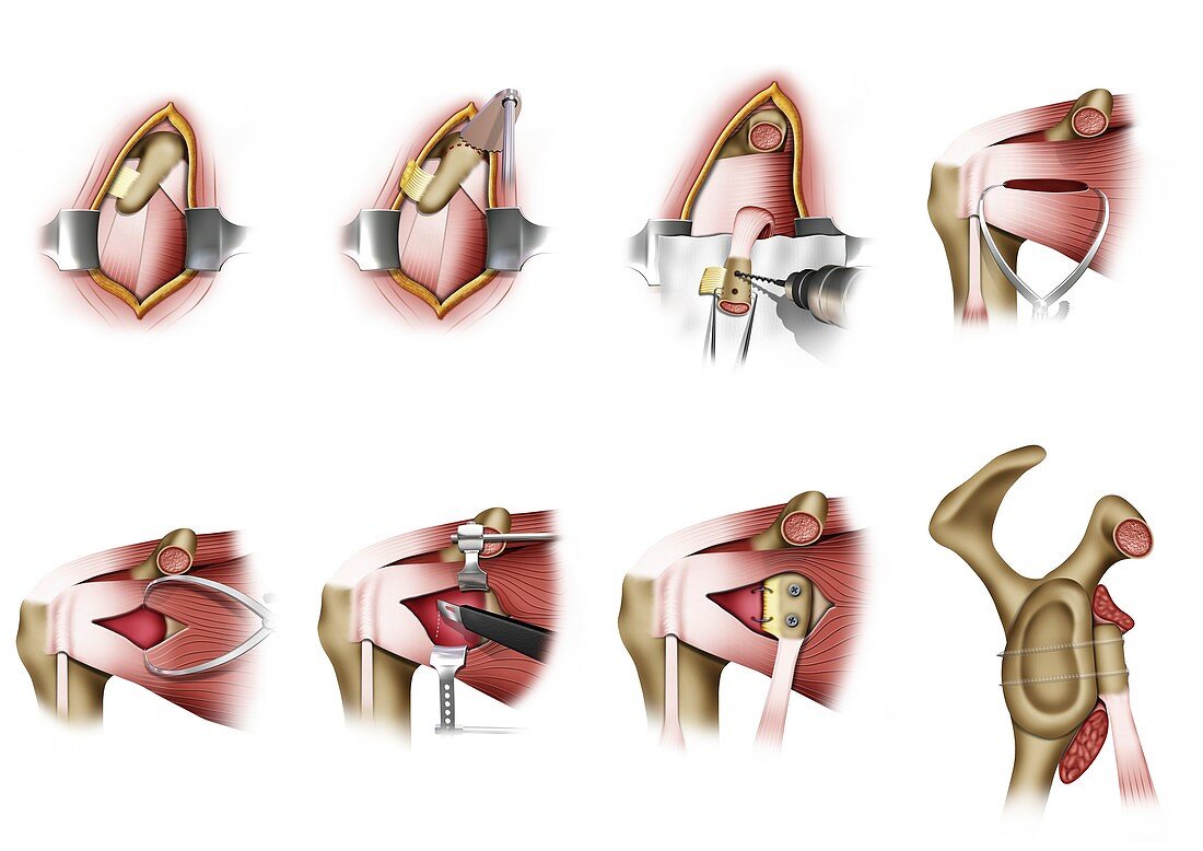 Shoulder dislocation prevention surgery, illustration