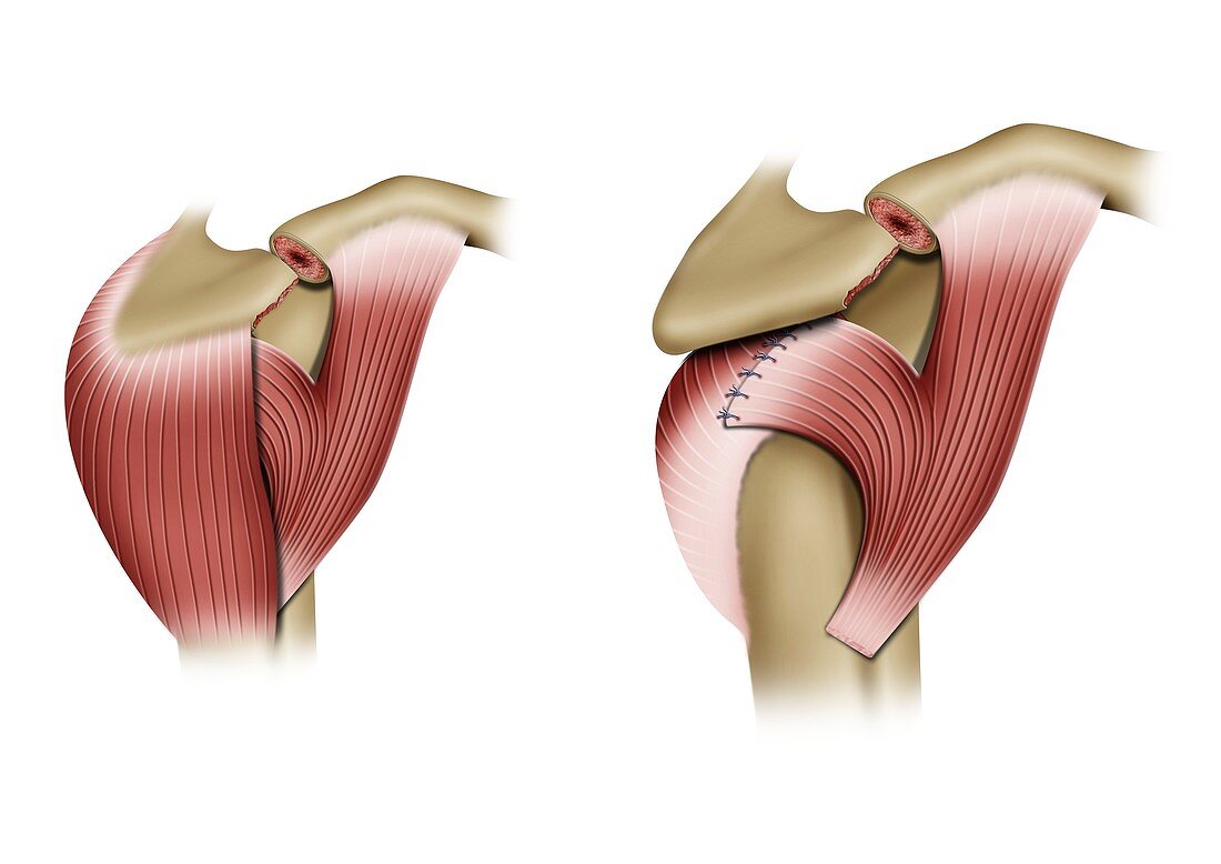 Acromion shoulder surgery, illustration