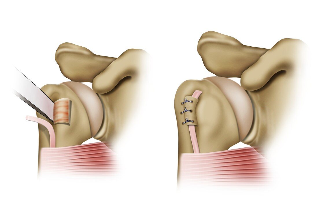 Hitchcock procedure shoulder surgery, illustration