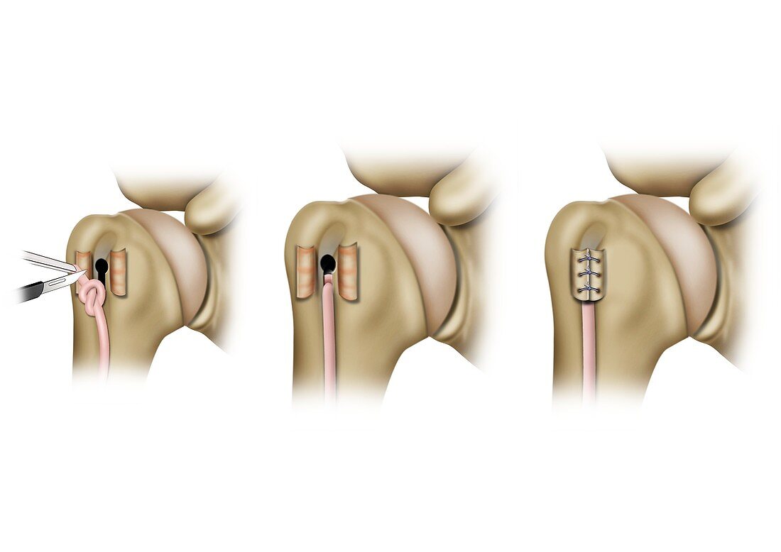 Keyhole shoulder tendon surgery, illustration