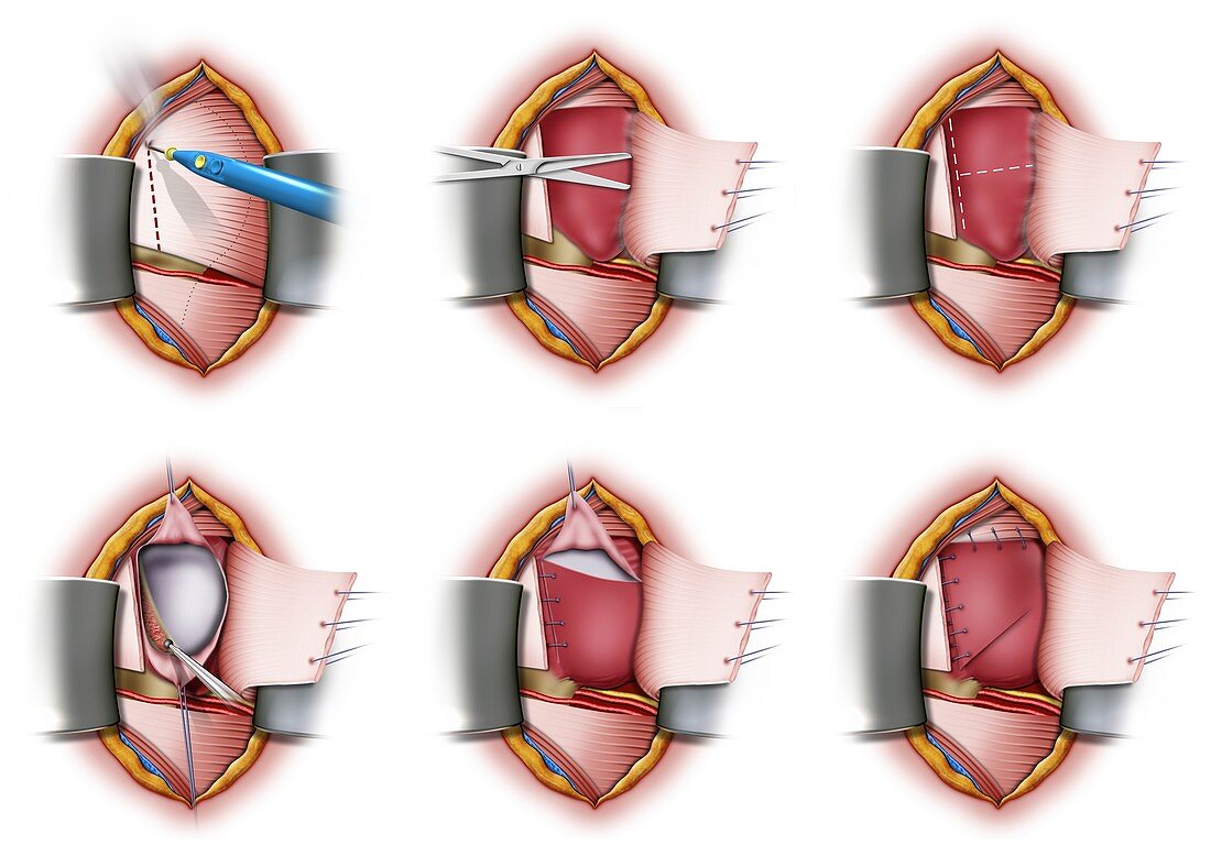 Neer procedure shoulder surgery, illustration