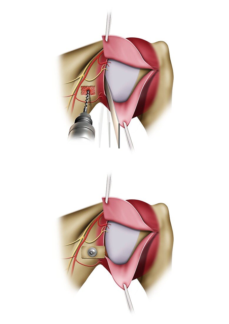 Arthroereisis shoulder surgery, illustration