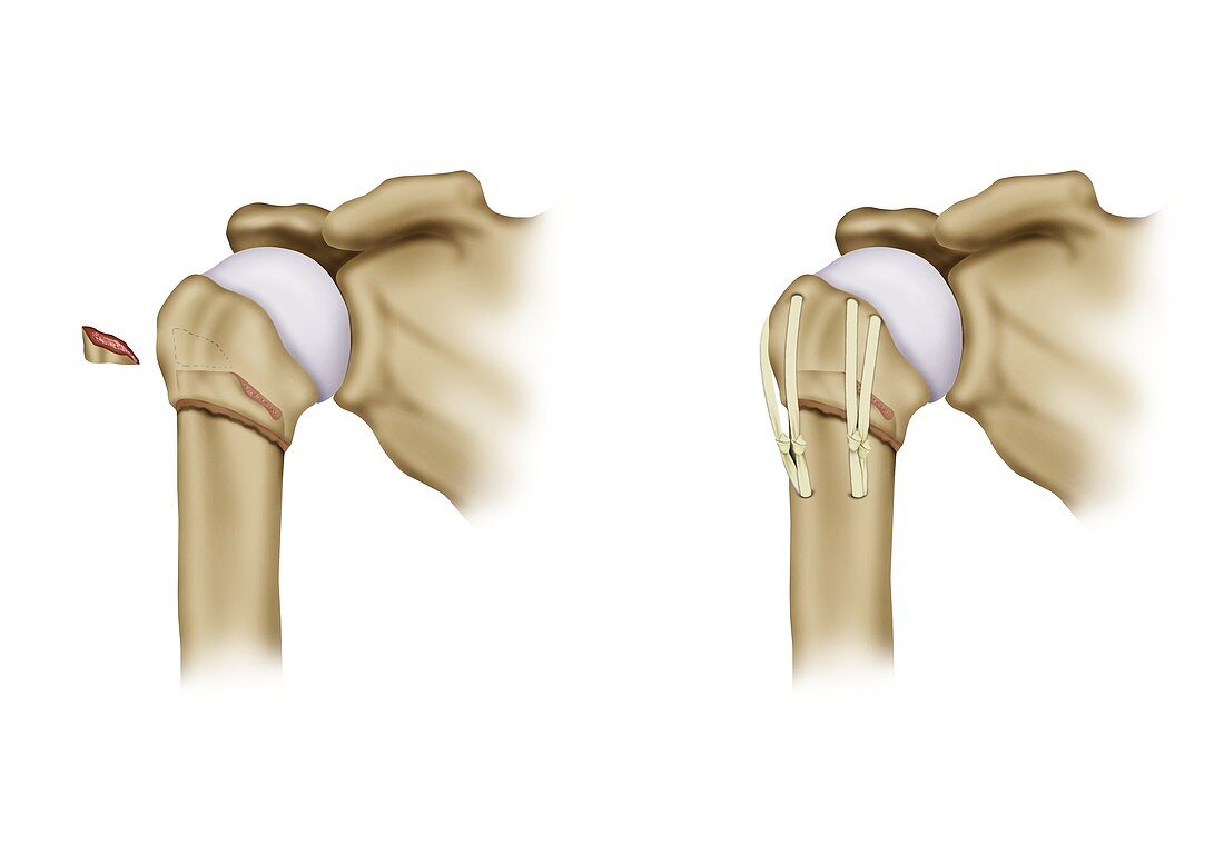 Shoulder bone reduction surgery, illustration