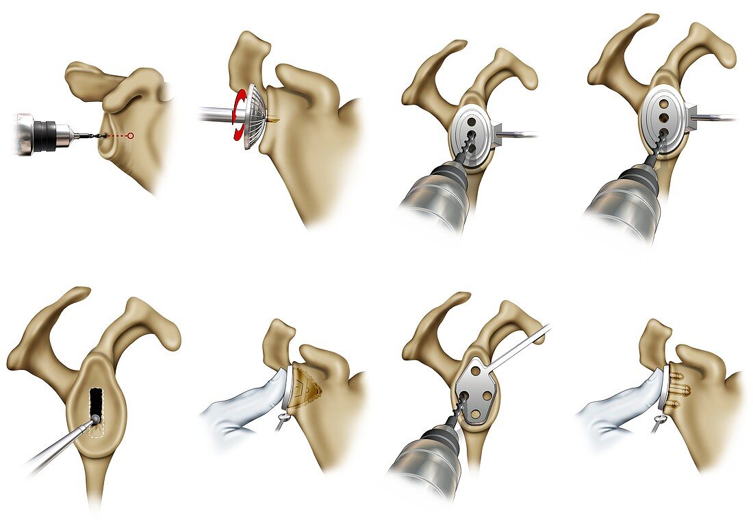 Shoulder implant surgeries, illustration