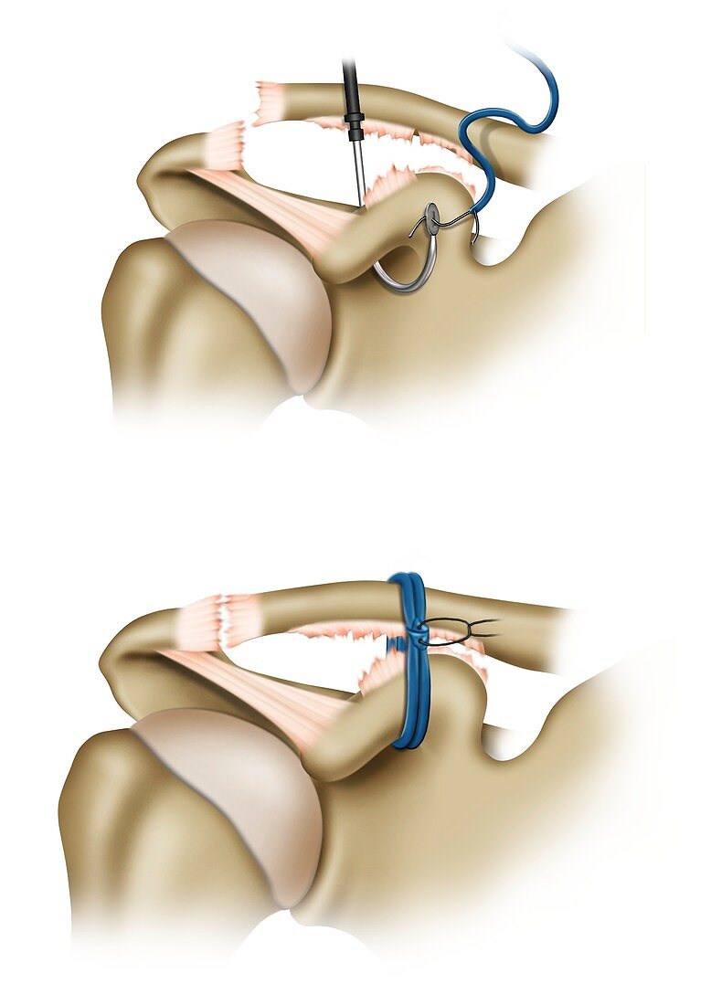 Dacron ligament prosthesis shoulder surgery, illustration