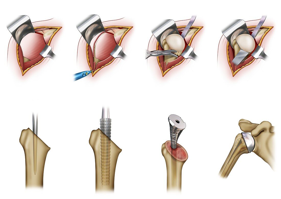 Humeral prosthesis shoulder surgery, illustration