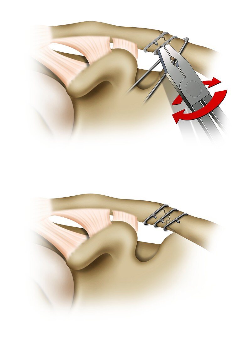 Clavicle fracture repair surgery, illustration