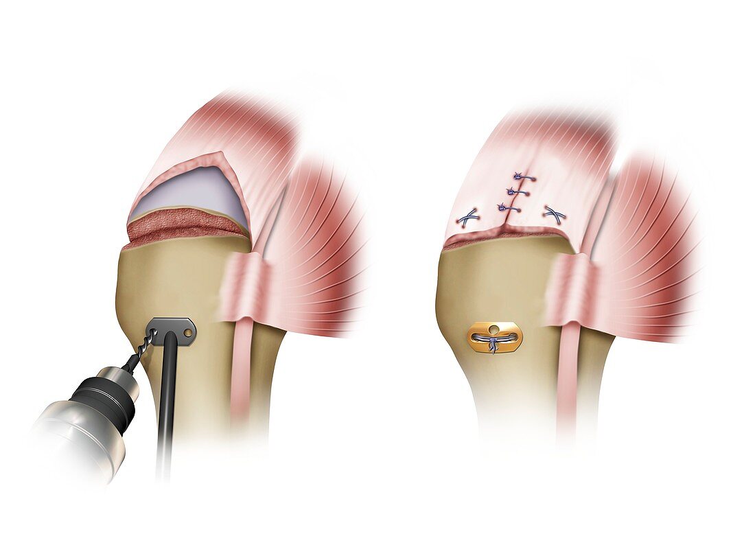 Plate and suture placement in shoulder surgery, illustration