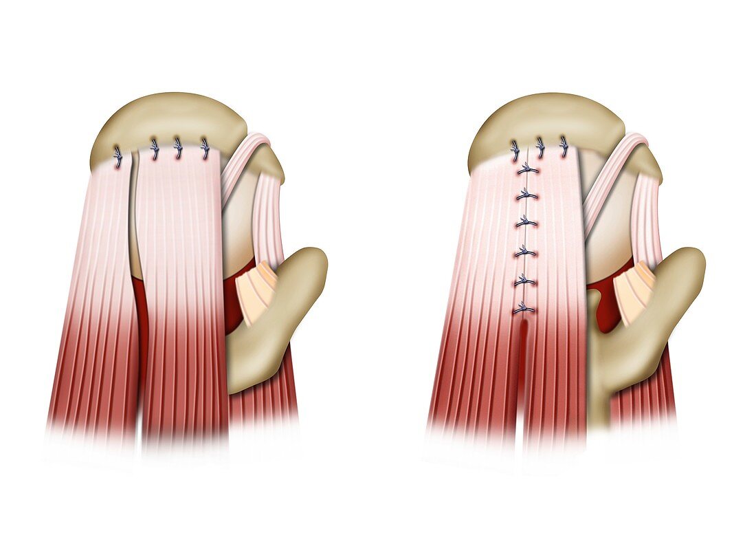 Sutures used in shoulder surgery, illustration