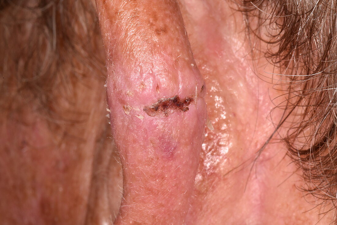 Scar after basal cell carcinoma excision