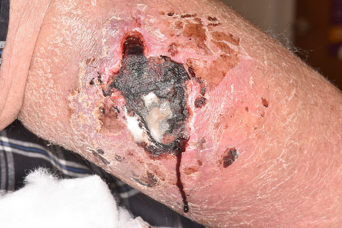 Leg wound following a fall