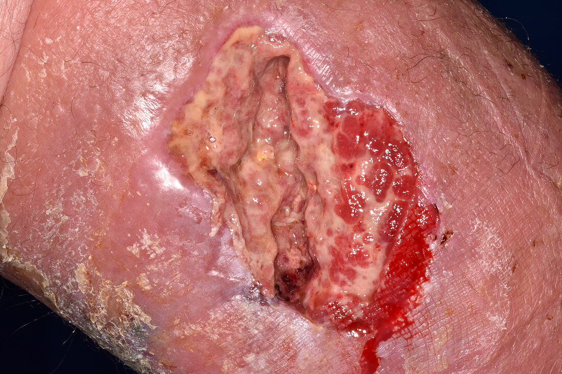 Leg wound treatment following a fall