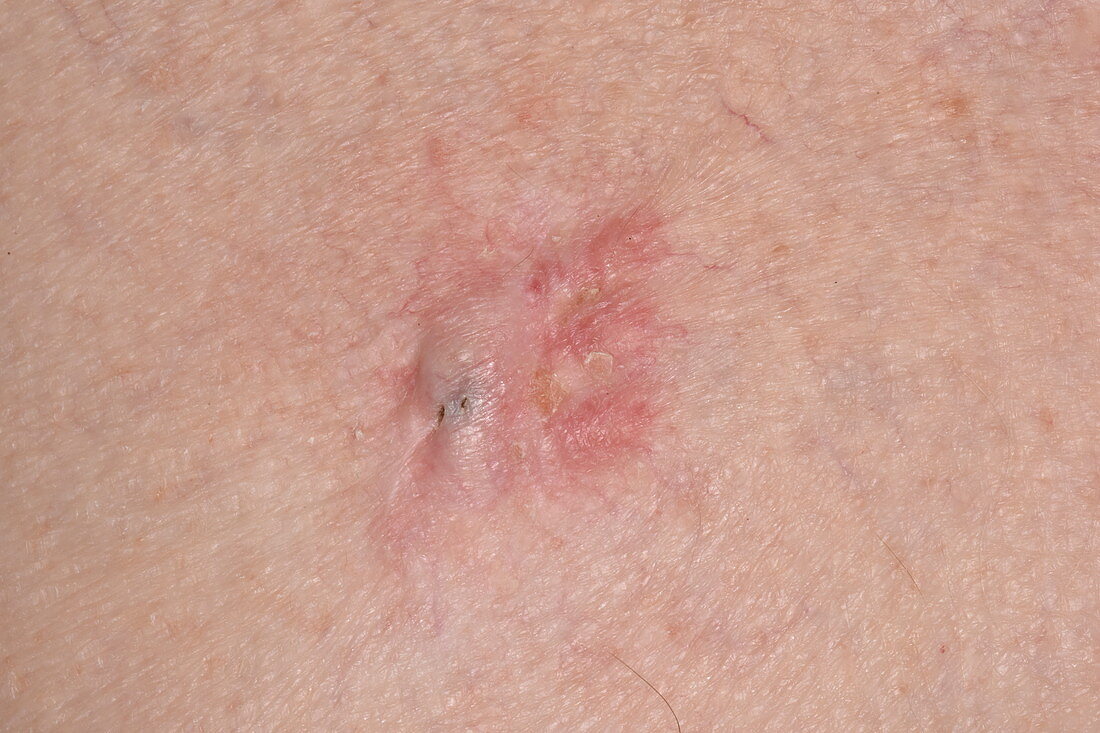 Sebaceous cyst scar