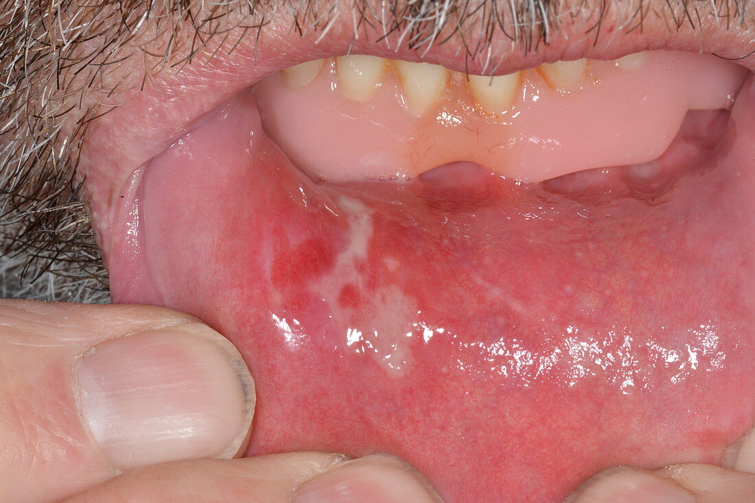 Mouth ulcer inside lower lip
