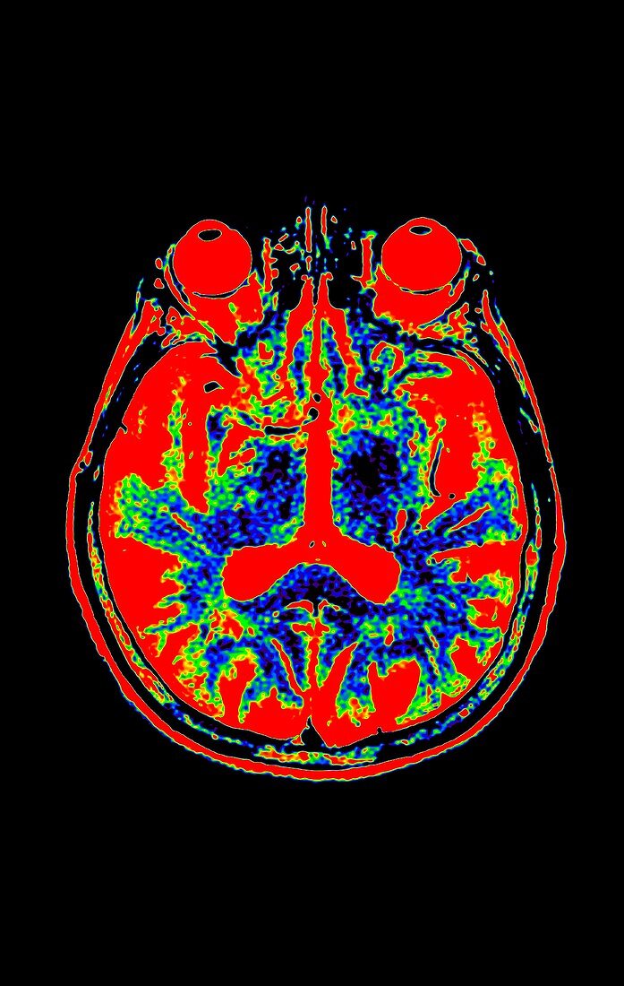 Human eyes and brain, axial MRI scan