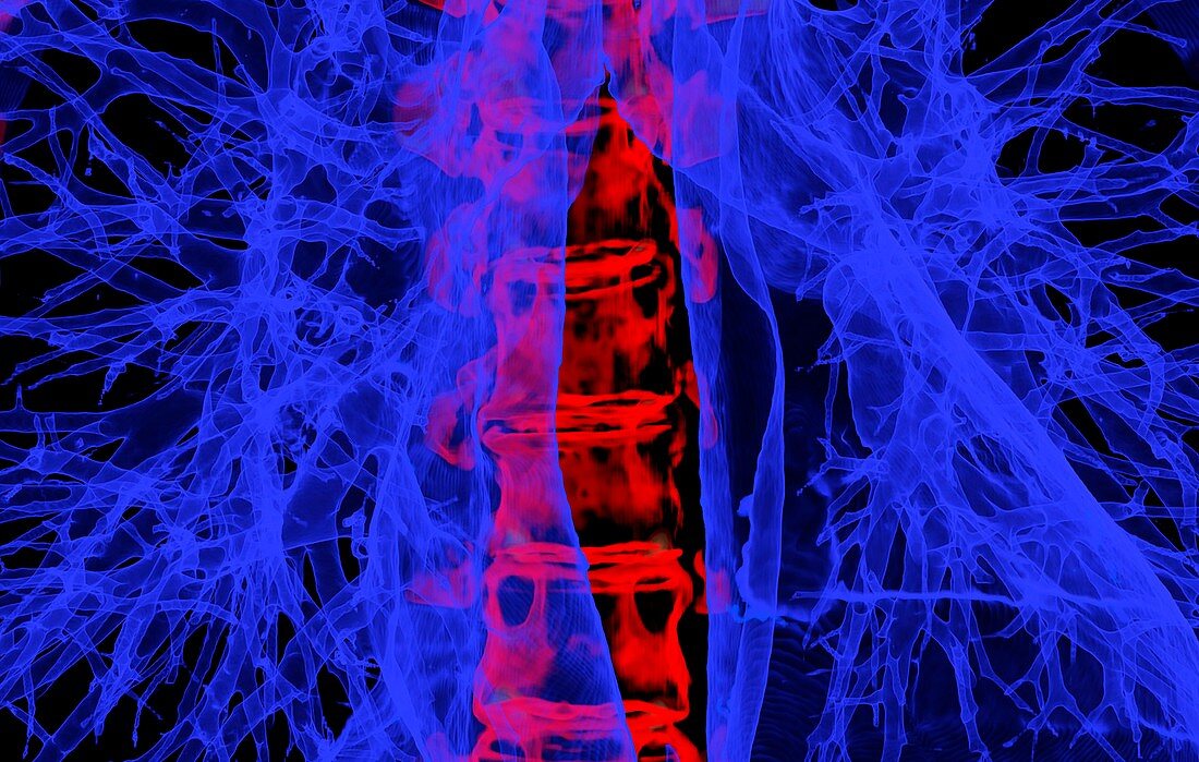Lung airways and backbone, 3D CT scan