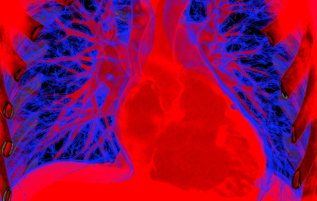 Heart and lungs, 3D CT scan