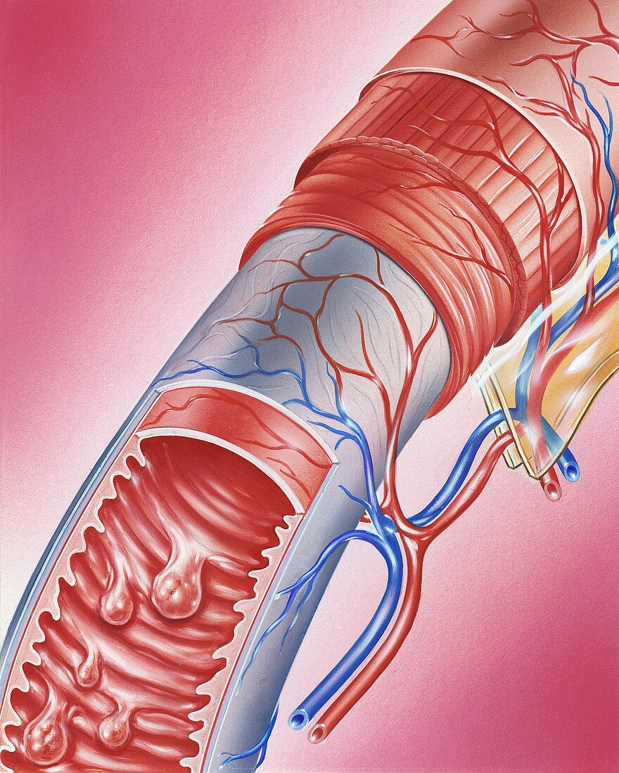 Polyposis of the small intestine, illustration
