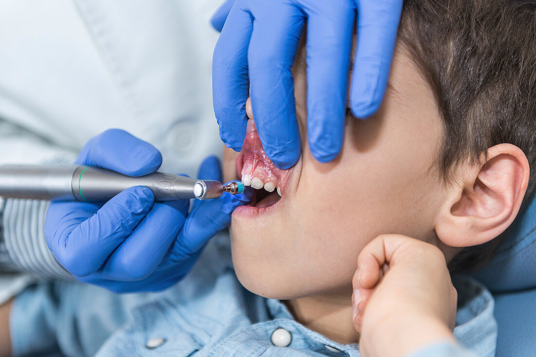 Removing dental calculus from boy's teeth