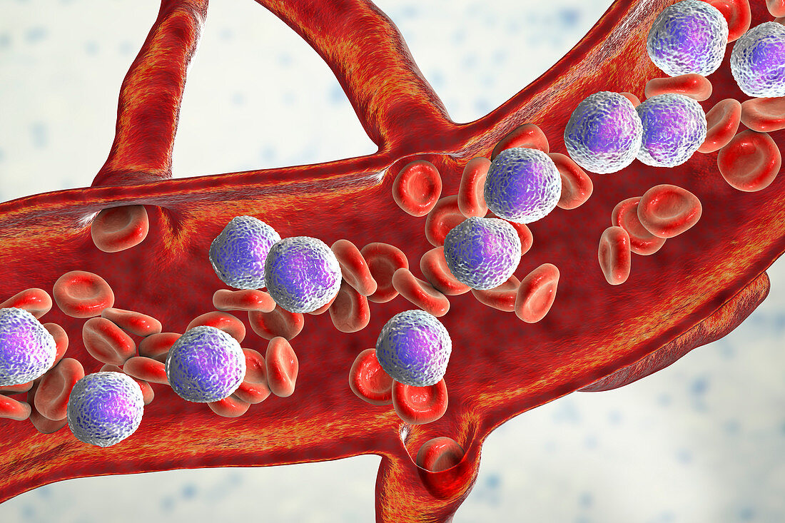 Acute lymphoblastic leukaemia, illustration