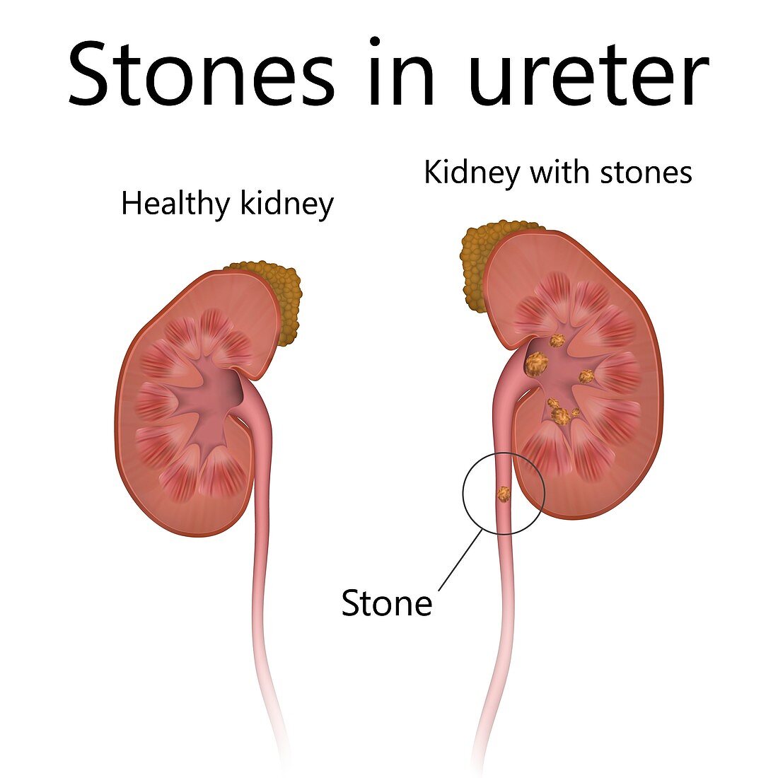 Normal kidney and kidney with stones in ureter, illustration