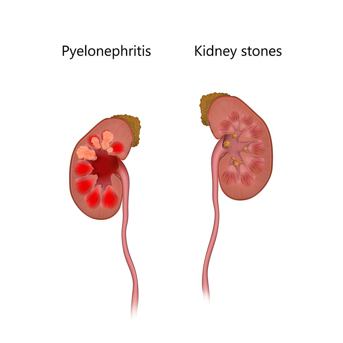 Pyelonephritis and kidney with stones, illustration
