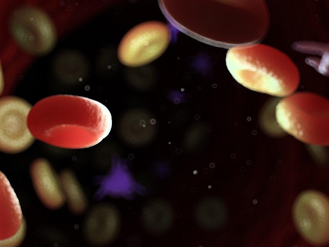 Diseased blood cells, illustration