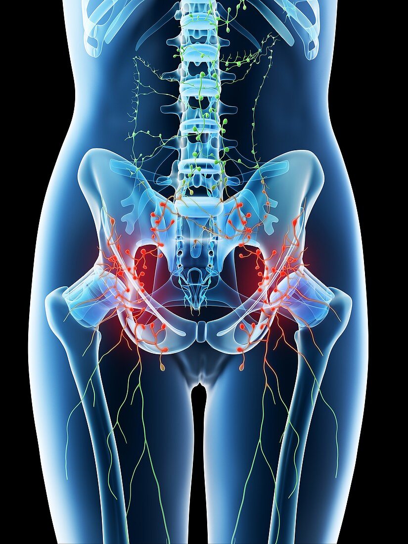 Enlarged abdominal lymph nodes, conceptual illustration