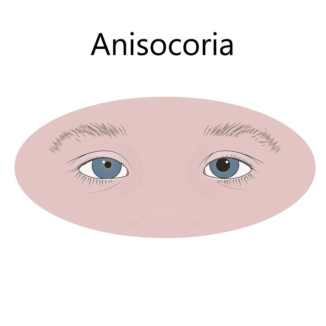 Childhood anisocoria, illustration